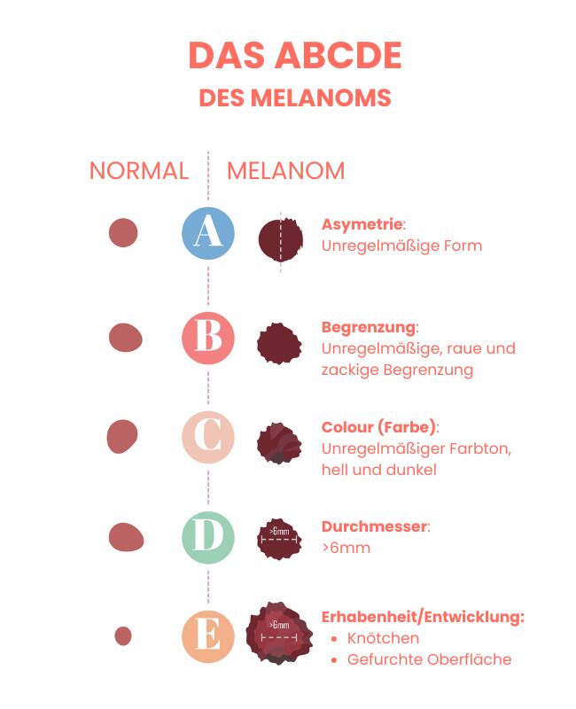 Infografik zur ABCDE-Regel bei Melanom: Sie vergleicht einen normalen, gleichmäßig geformten Leberfleck mit auffälligen Hautveränderungen und zeigt die Warnzeichen Asymmetrie, unregelmäßiger Rand, unterschiedliche Farben, Durchmesser über 5–6 Millimeter und Veränderung in Größe oder Form.